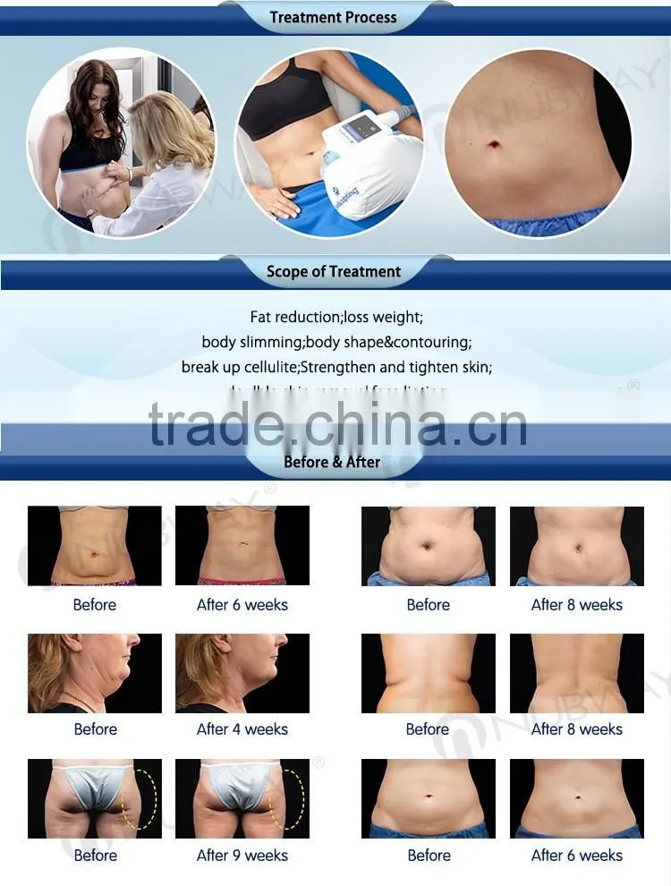 CE / FDA approved 10.4 inch touch screen popular body shaping cool lipo sculpting fat weight loss cool sculpting machines