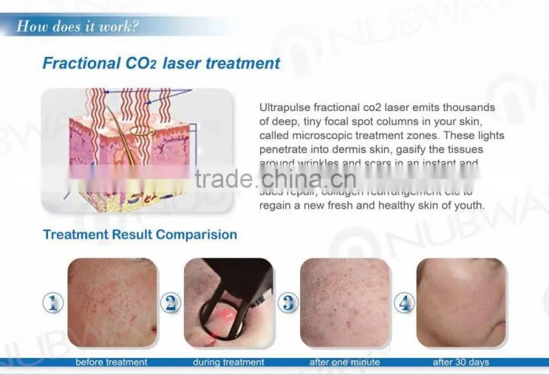 RF tube Fractional CO2 Laser Machine NBW-FII with vaginal handles