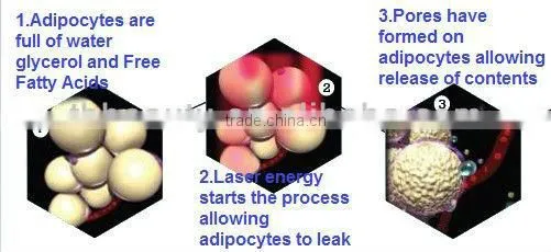 940nm Weight Loss Lipo Laser Machine with Japanese Mitsubishi Diode Laser Light