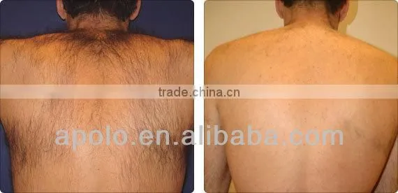 Apolomed 808nm diode laser hair removal machine skin rejuvenation hair removal diode laser