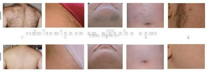 lady epilator hair removal face/good quality device for hair removal face