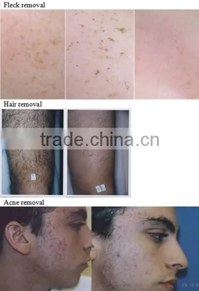Intense Pulsed Light Therapy IPL System A005