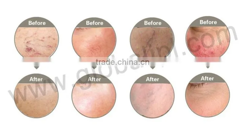 2016 Globalipl NEW MACHINE 980nm laser spider vein removal