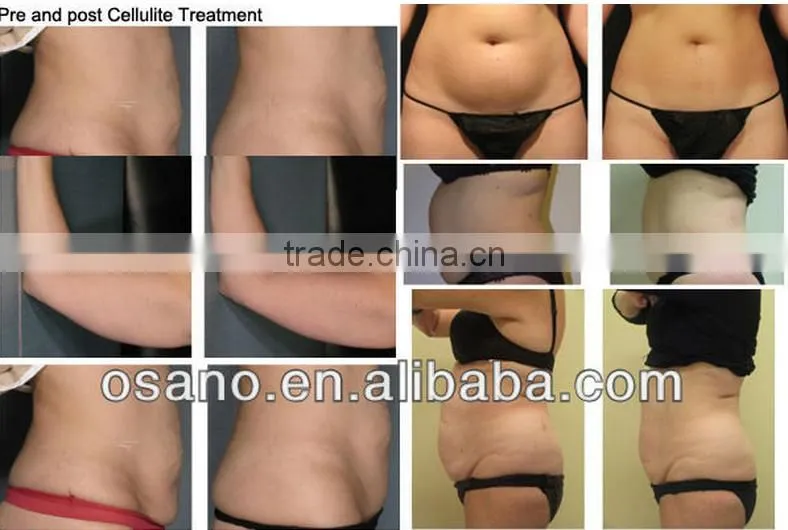 Newest Portable Vacum Slimming Machines Cryotherapy Devices