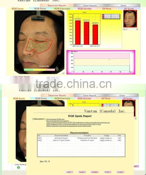 Most Advanced Intelligent 15Mega Pixel fs-1500 magic skin analyzer