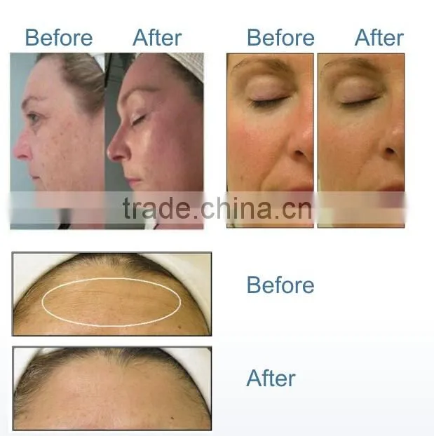 Portable Oxygen Infusion and microdemermabrasion machine with video trainning