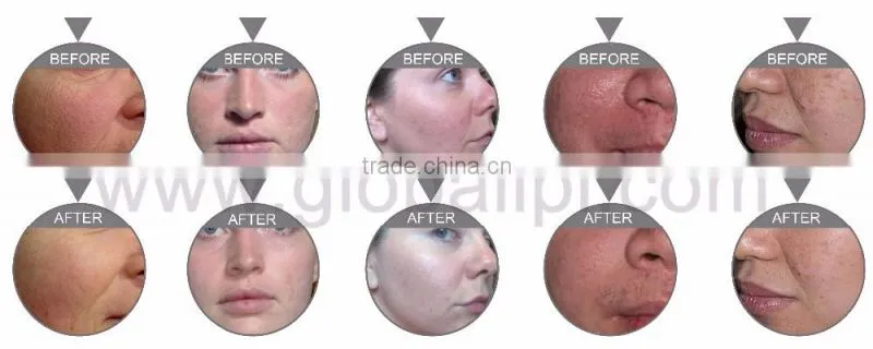 face moisturizing skin whitening portable water oxygen beauty machine