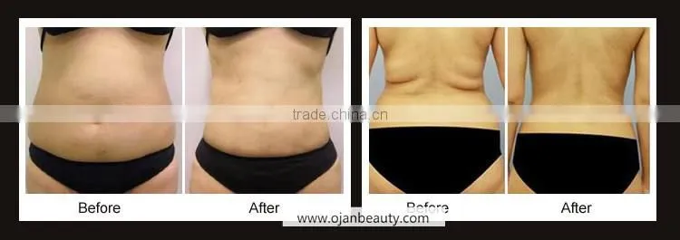Non-invasive Fat Reduction Liposonic HIFU Machine for Body Slimming