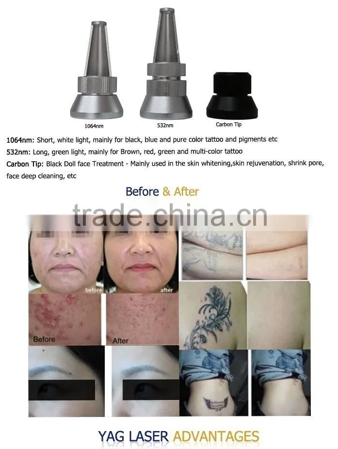 Freckle removal laser nd yag q-switched
