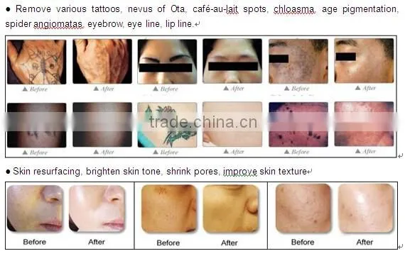 Professional Laser Tattoo removal beauty machine , tattoo removal q switch nd yag laser
