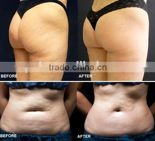 Factory supply directly Cavitation and Vacuum slimming system