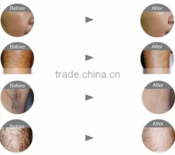 portable IPL SHR hair removal machine/IPL+RF/IPL SHR made in China with competive price
