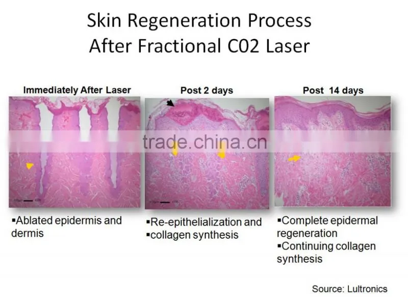 RF Co2 Fractional Laser Fractional Laser Treatment