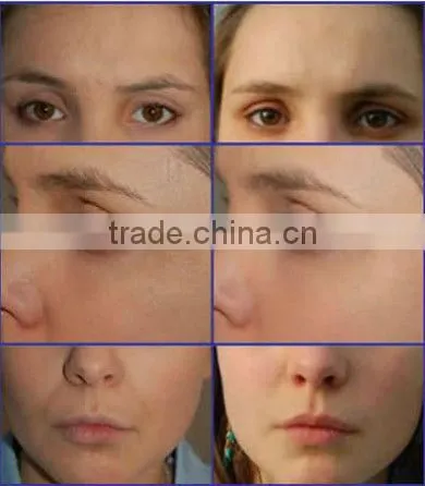 facial exercise machines for home use tm-270