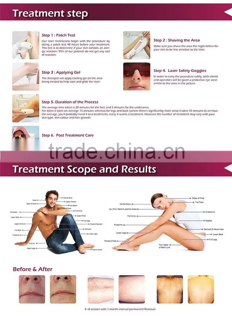 Medical portable 808nm laser professional diode laser hair removal
