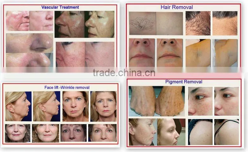 ipl & rf equipment for hair removal and RF high frequency for skin tightenng
