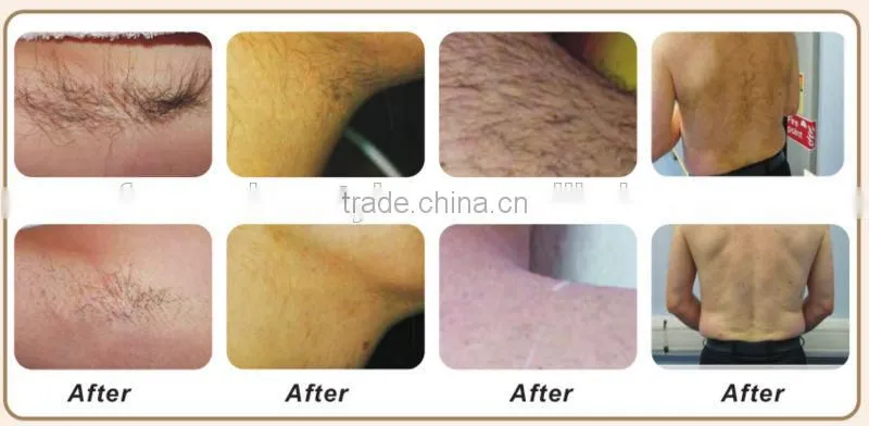 2014 Newest And Fashional Micro Channel 808nm Diode Laser Machine-DIOD-III
