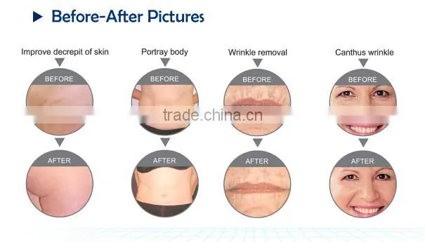 2015 home popular portable RF system_skin tightening monopolar