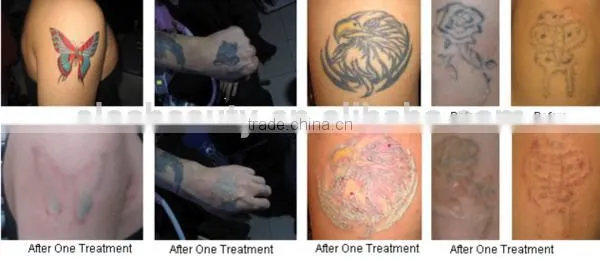 8.4 inch touch screen q switched nd yag laser tattoo removal