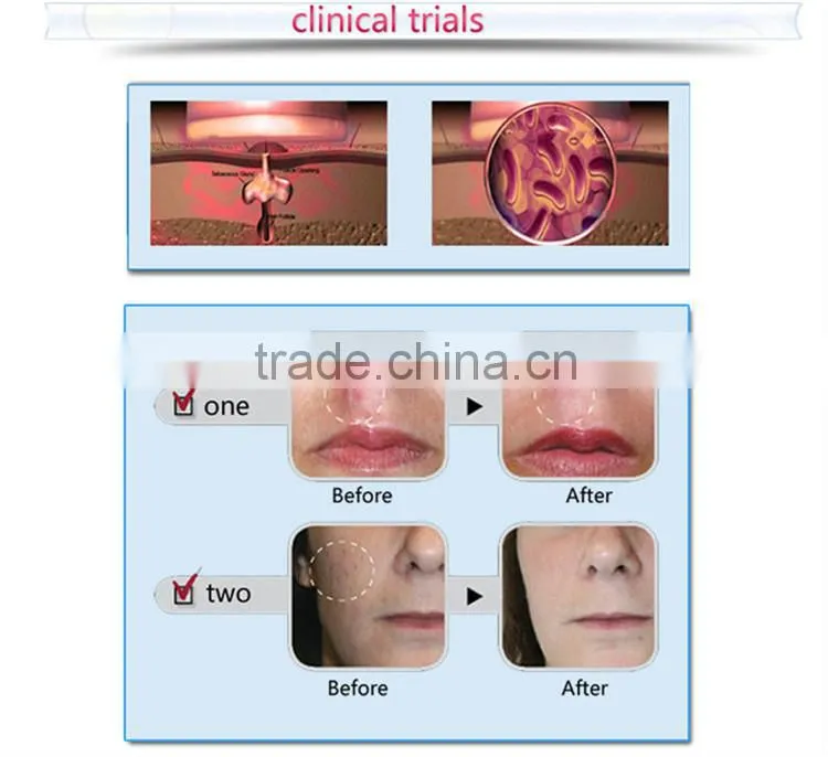 Best effective hot sale soft acne laser removal/acne treatments pen for sale