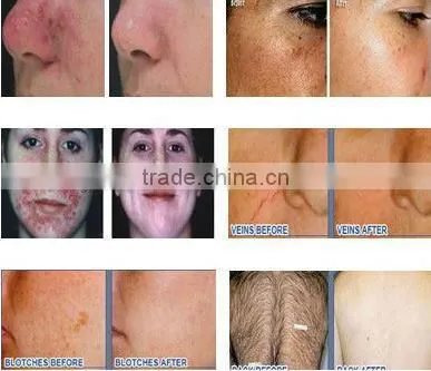 Portable Hair Removal Laser Machine Prices