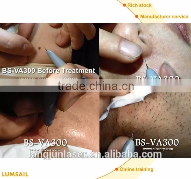 Spider Vein Removal/Vascular Removal