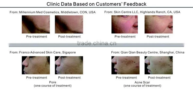 New Design Light Therapy and Diamond Microdermabrasion Peeling Machine