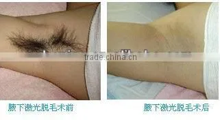 E6 2016 painless IPL/E-light laser hair removal machine