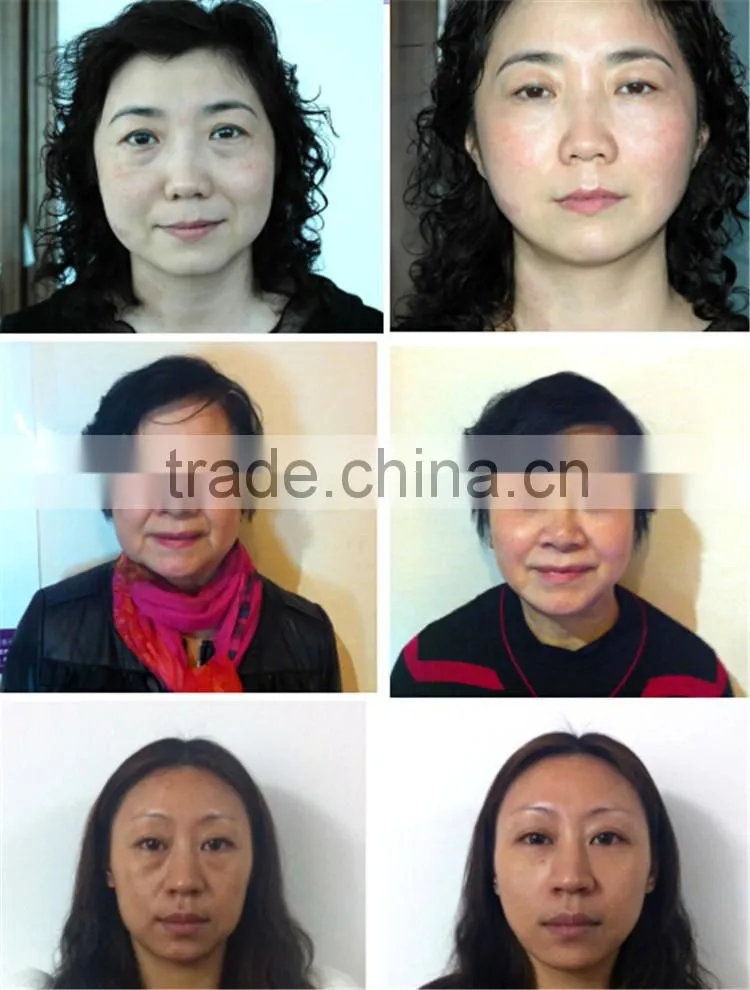 Portable amageing effective best home rf skin tightening face lifting machine