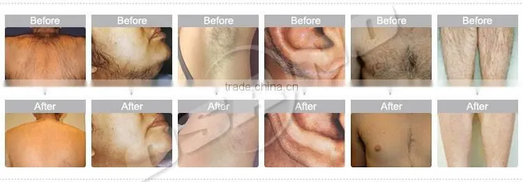 Portable IPL Machine With New Appearance Skin Rejuvenation Beauty Machine