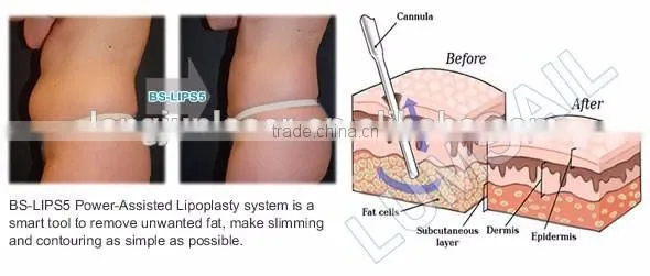 Liposuction Surgery Use Liposuction for Plastic Surgeon