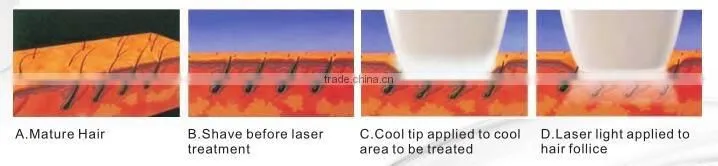 Good effective laser hair removal equipment of jmshr 808