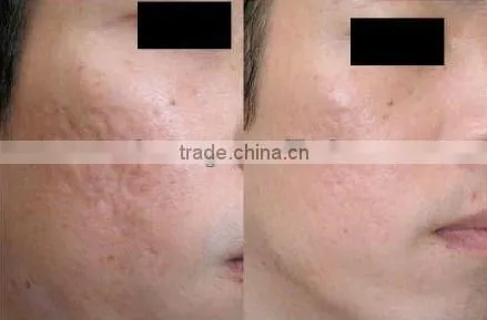 hot selling products wrinkle removal acne removal microneedling pen EL011