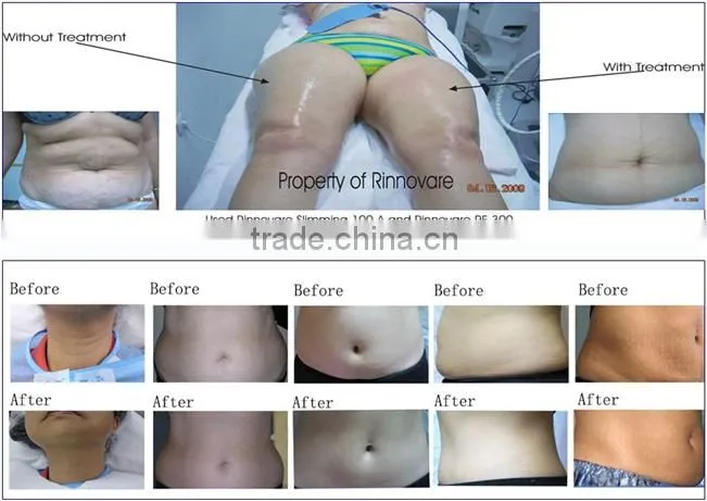 kuam shape Body Slimming Machine System liposuction slimming arm massage machine beauty