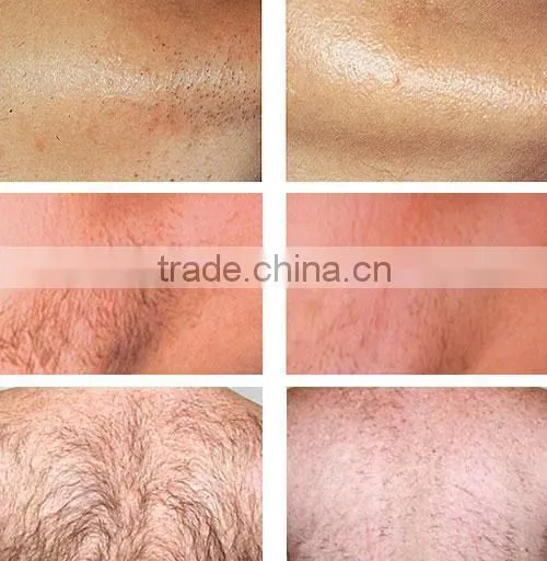IPL OPT Permanent Hair Removal Ipl