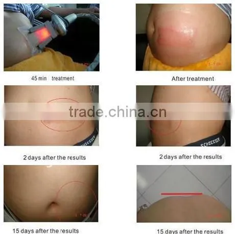 cryolipolysis +cavitation+RF+laser+Vacuum