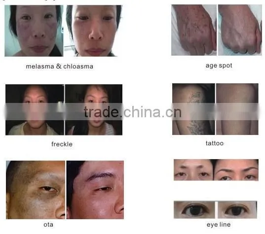 Professional Q switched nd yag best laser tattoo removal machine
