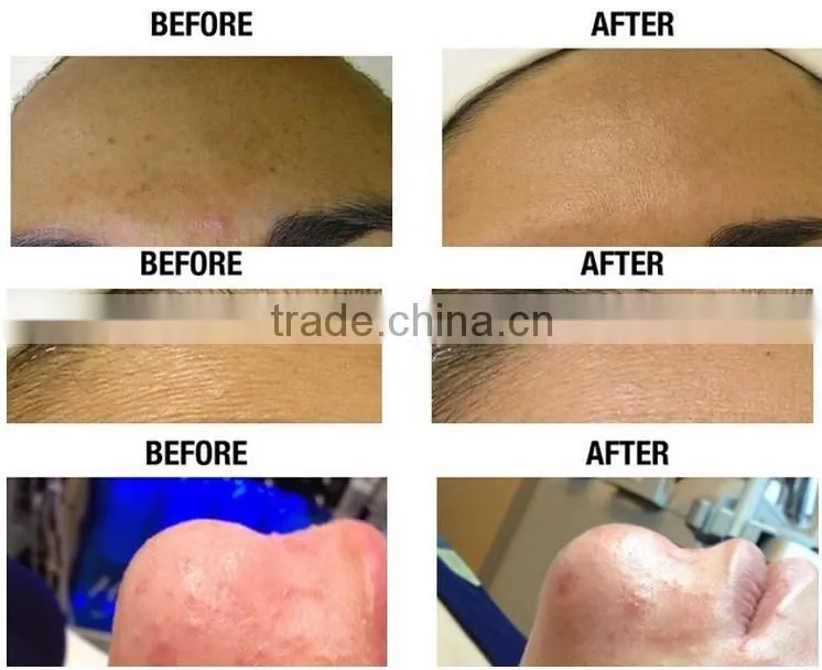 NL-SPA13 Foctory price ! microdermabrasion / diamond microdermabrasion for skin rejuvenation