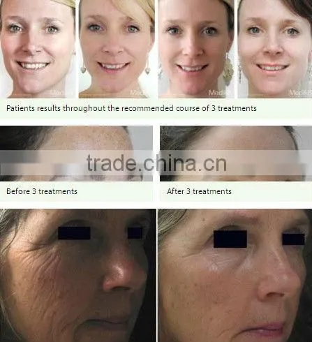 540 derma roller acupuncture needle beauty treatment