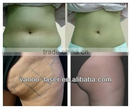 body vacuum suction machine