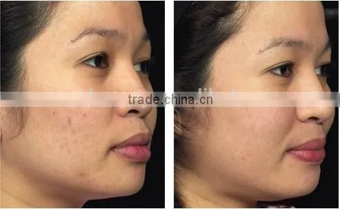 Face and Body Home IPL Hair Removal System ipl lamp with 100,000 shots