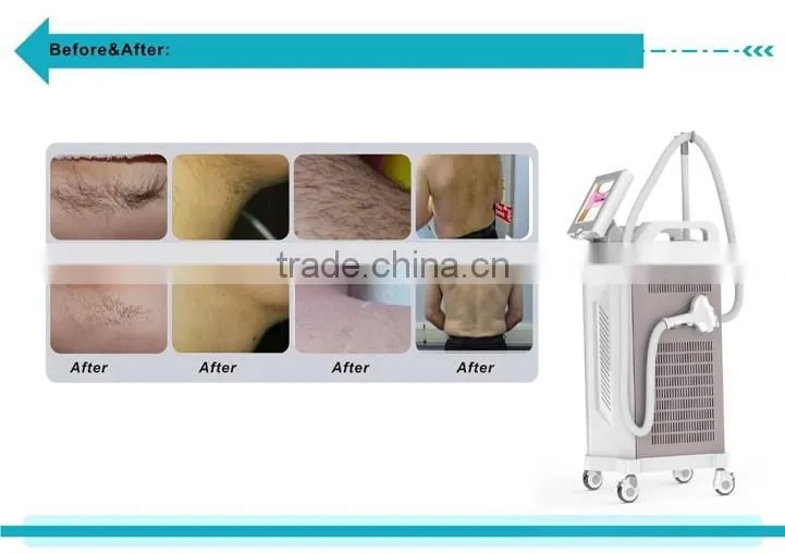 China factory 808nm diode laser permanent hair removal skin care machine for sale---DIDO-IV