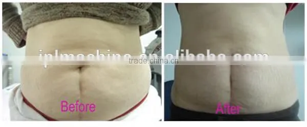explosive speed grease cavitation beauty machine