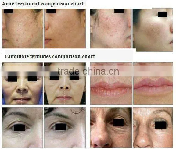 2012 New SL-44 CO2 fractional laser therapy nasal polyps resection