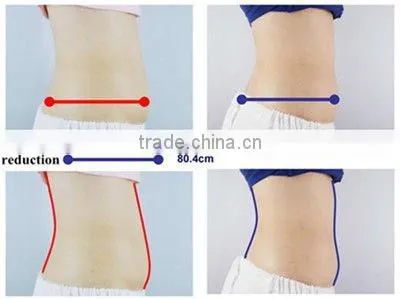 venze freeze machine for fat removal
