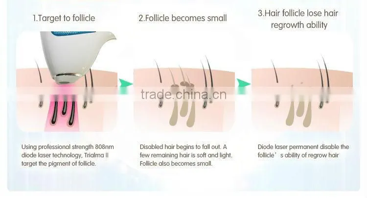 high quality mini 808nm diode laser hair removal device for home use