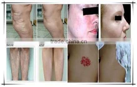 poweful and professional hair removal machine/ nd yag long pulse laser