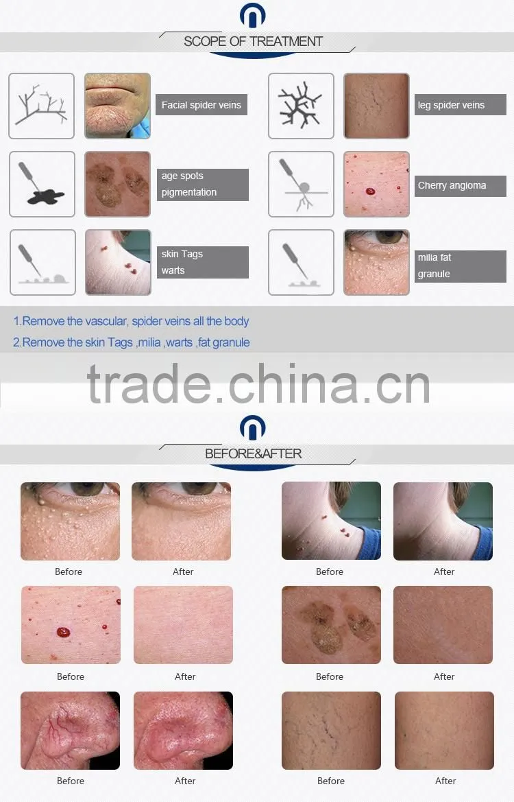 30MHz RBS maquina para quitar varices & machine to remove varicose veins