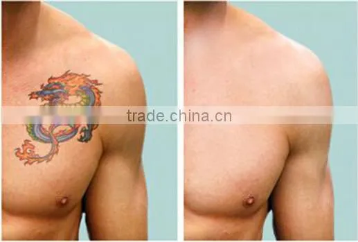 2013 HOT mini nd yag laser tattoo removal QS medical pigment removal q switched nd yag laser machine