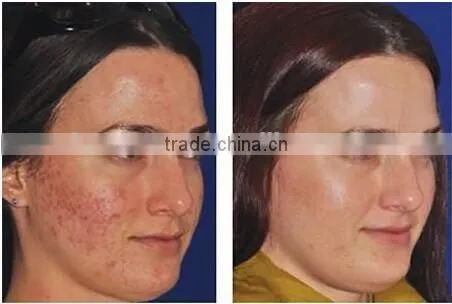 540 needles microneedle derma roller therapy ZGTS beauty roller